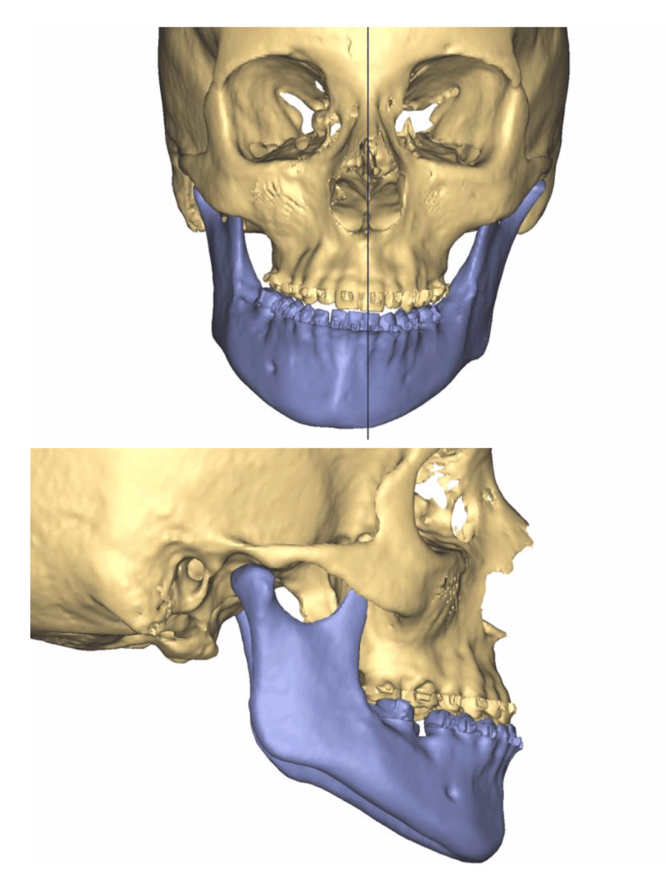 Animation showing the proposed plan of a typical double jaw surgery procedure.